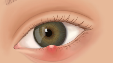 Arpacık (Hordeolum) Nedir, Belirtileri Nelerdir